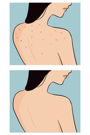 Buttoks Buttne Vücut Maskesi | Vücut Sivilceleri ve Pürüzlere Karşı | 2 Parça