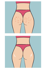 Buttoks Buttne Vücut Maskesi | Vücut Sivilceleri ve Pürüzlere Karşı | 2 Parça