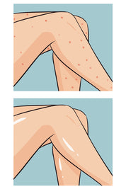 Buttoks Buttne Vücut Maskesi | Vücut Sivilceleri ve Pürüzlere Karşı | 2 Parça